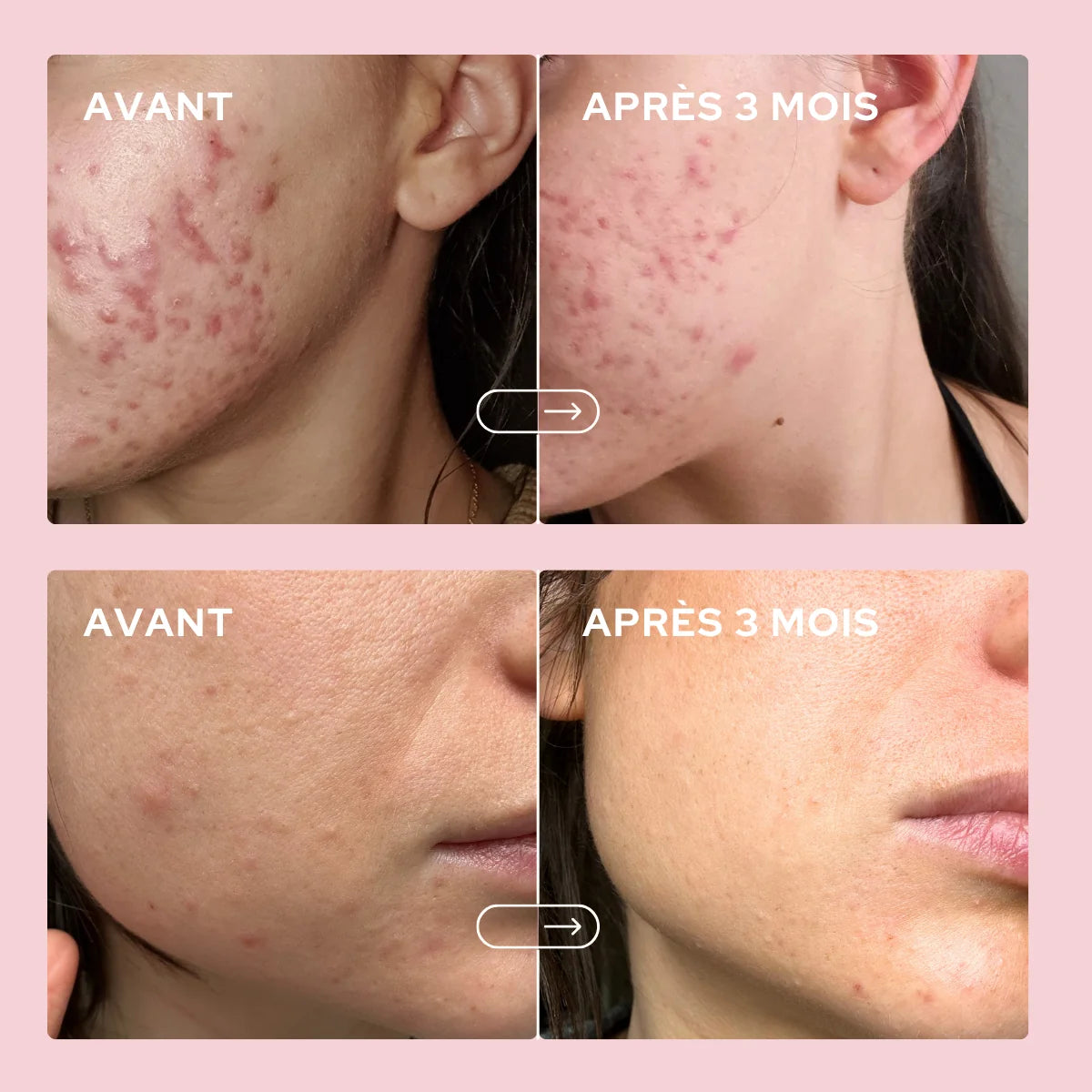 Gummies anti-imperfections - Epycure (Nouveauté en précommande)